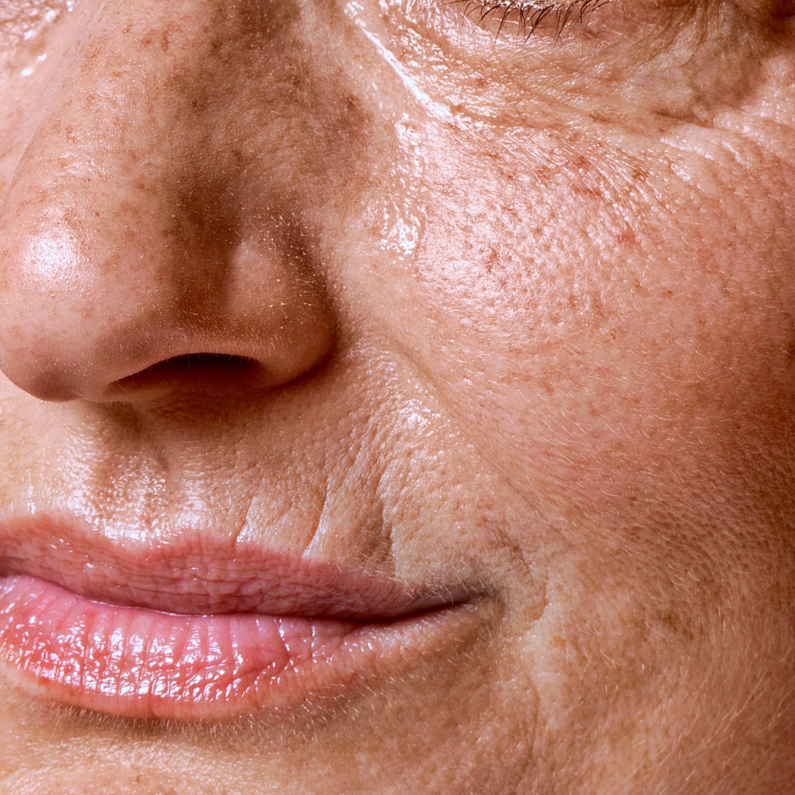 Melasma sem mistérios: é ou não possível tratar essa condição?