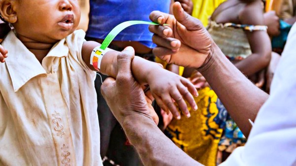 Médicos Sem Fronteiras e empresas fecham parcerias no Dia de Doar para ampliar combate à desnutrição